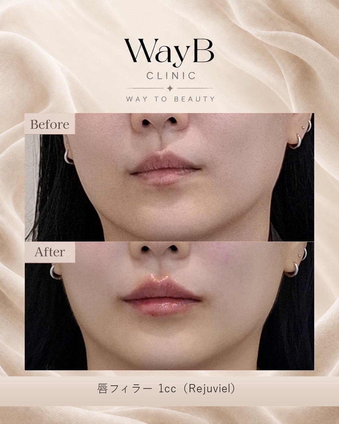 唇のヒアルロン酸注入 Case 4 Before & After
