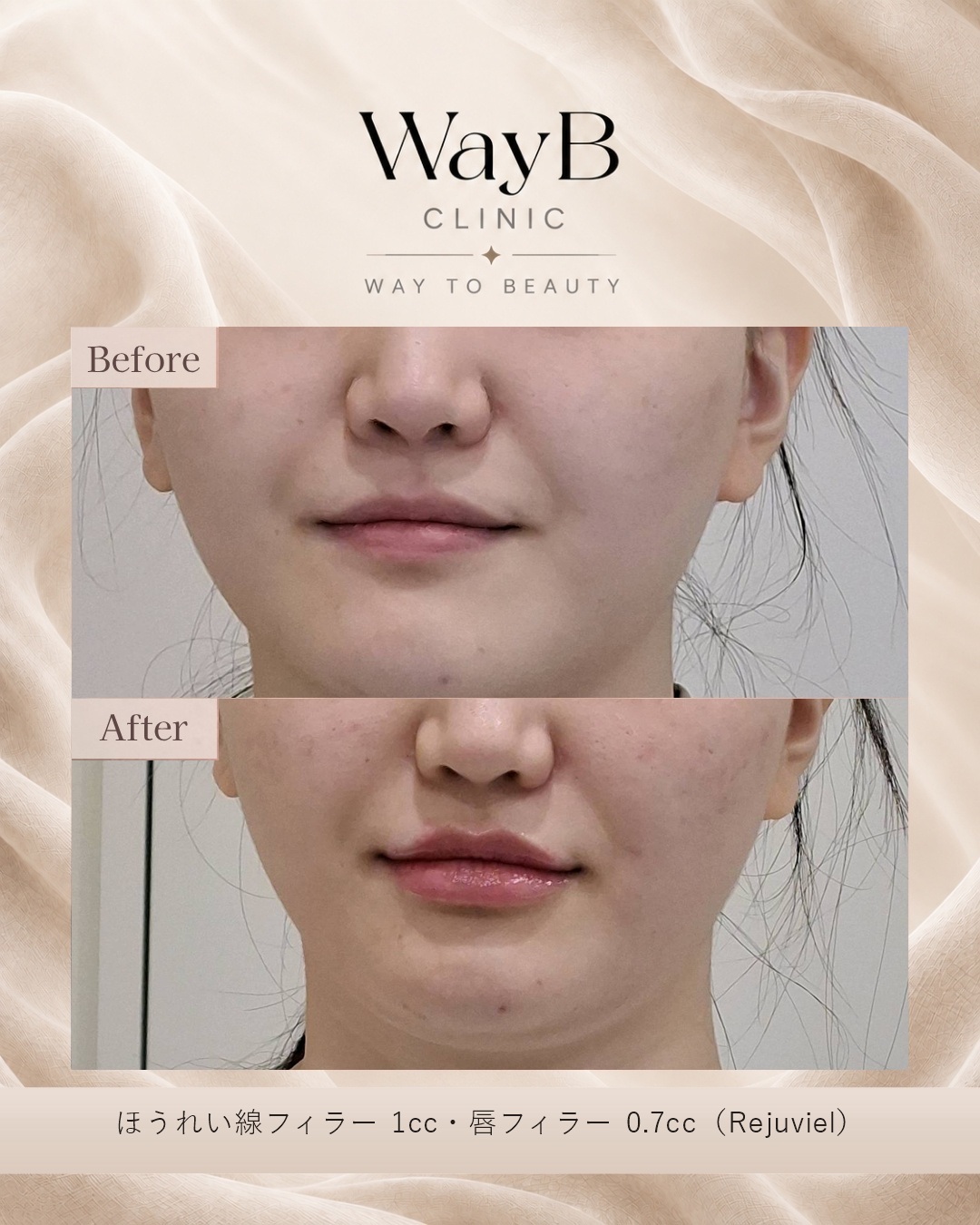 唇のヒアルロン酸注入 Case 5 Before & After
