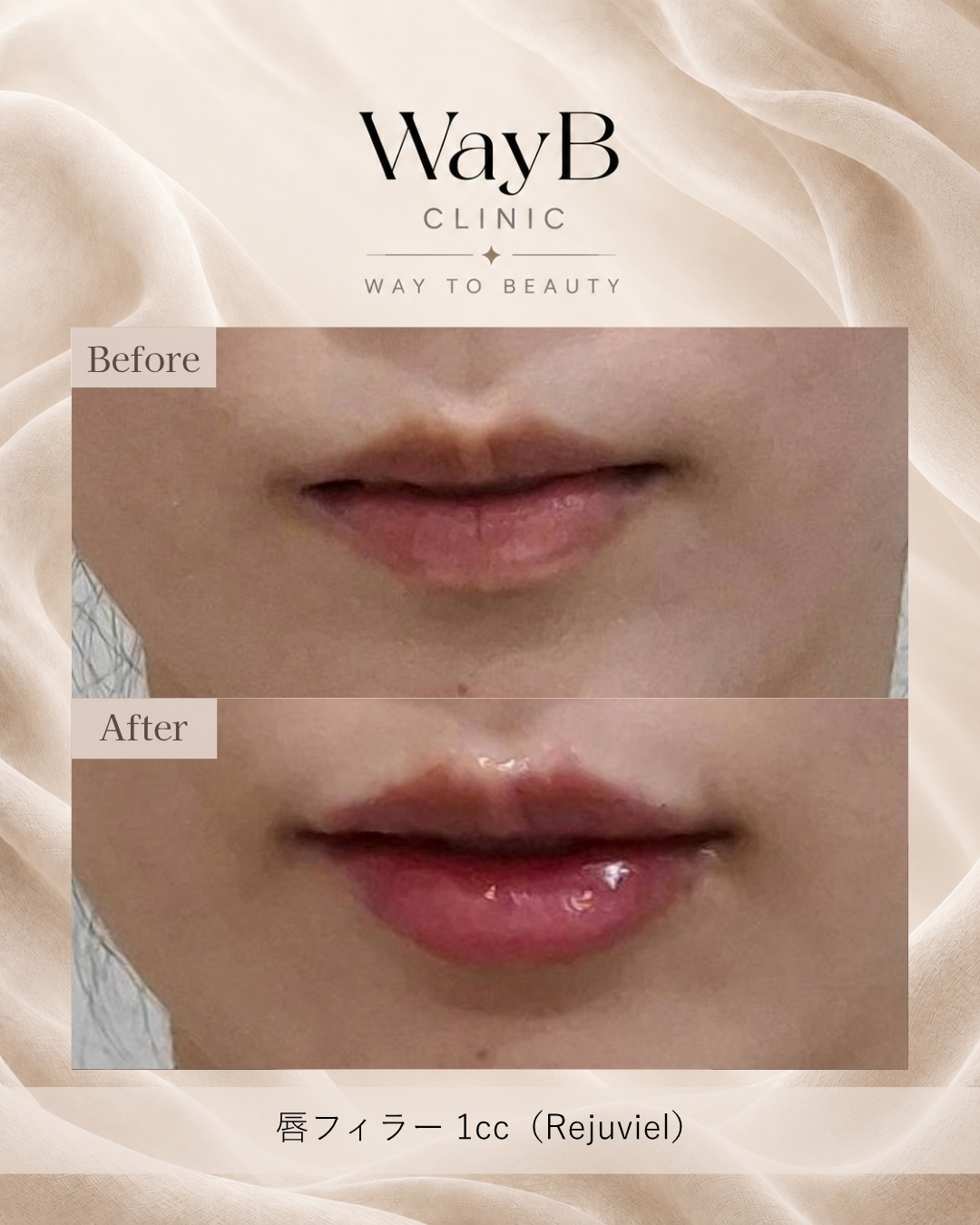 唇のヒアルロン酸注入 Case 8 Before & After