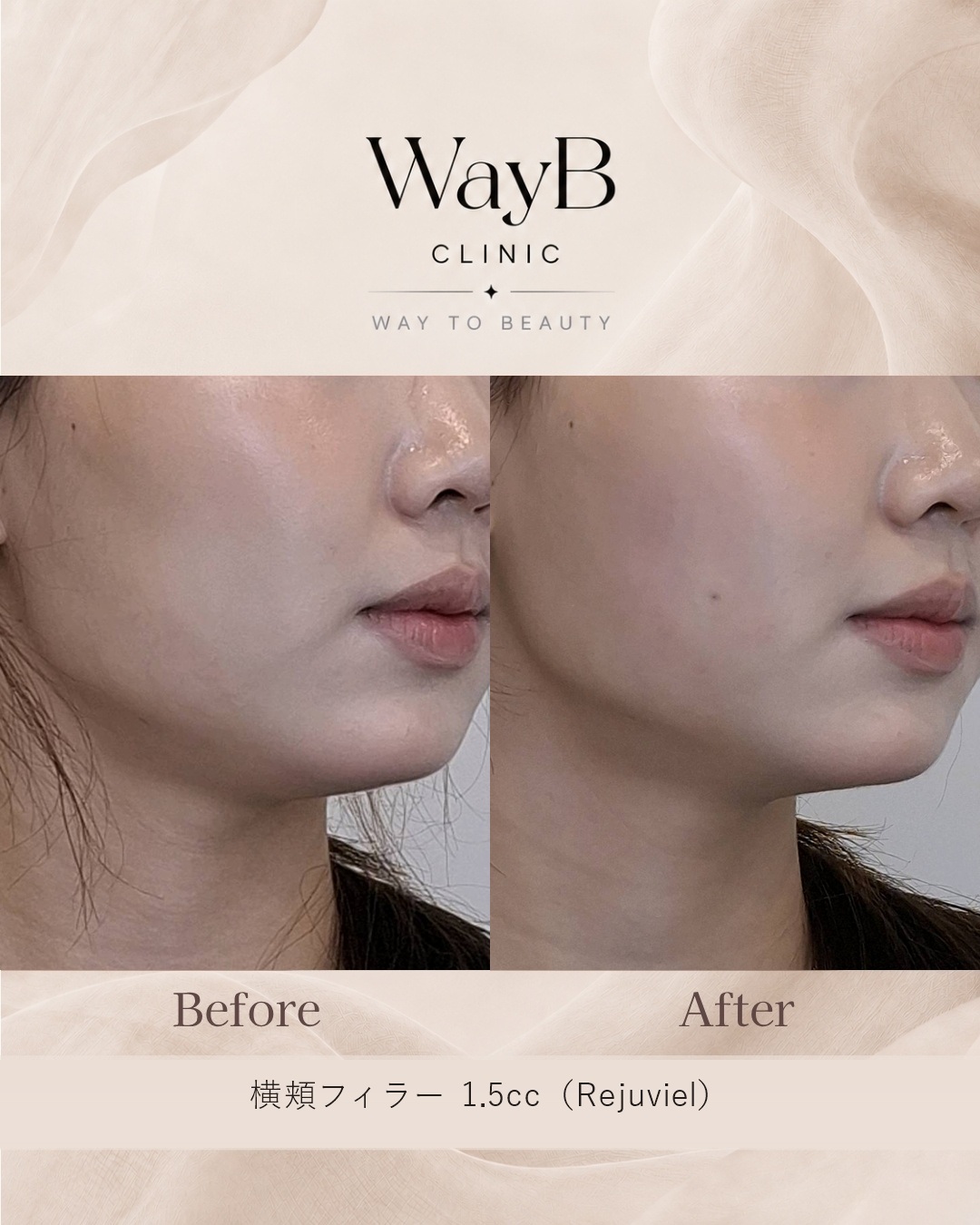 頬・頬骨前面のヒアルロン酸注入 Case 2 Before & After