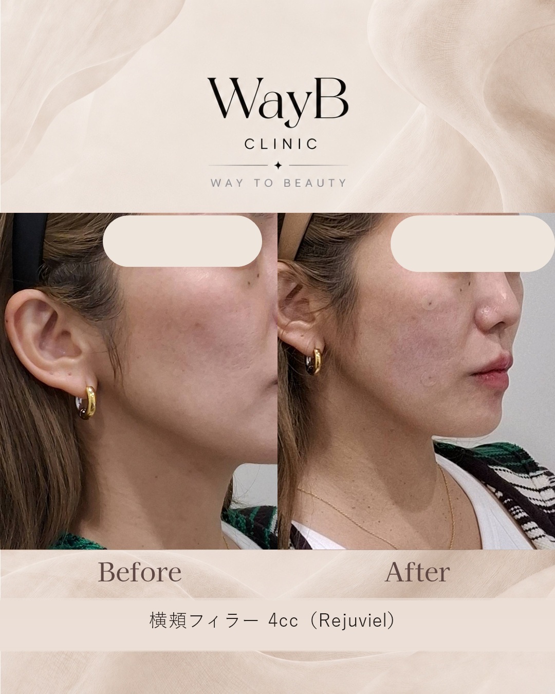 頬・頬骨前面のヒアルロン酸注入 Case 3 Before & After