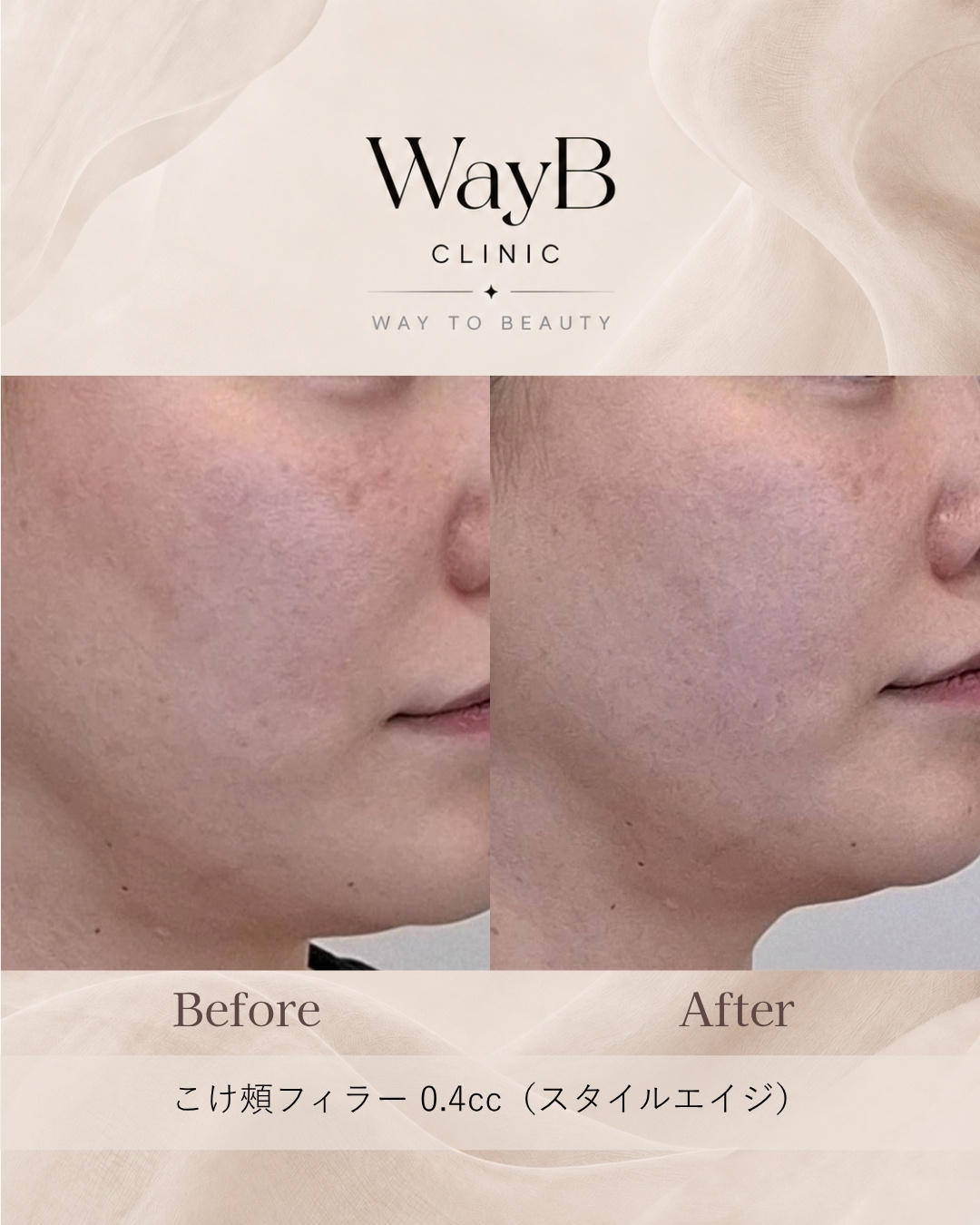 頬・頬骨前面のヒアルロン酸注入 Case 4 Before & After