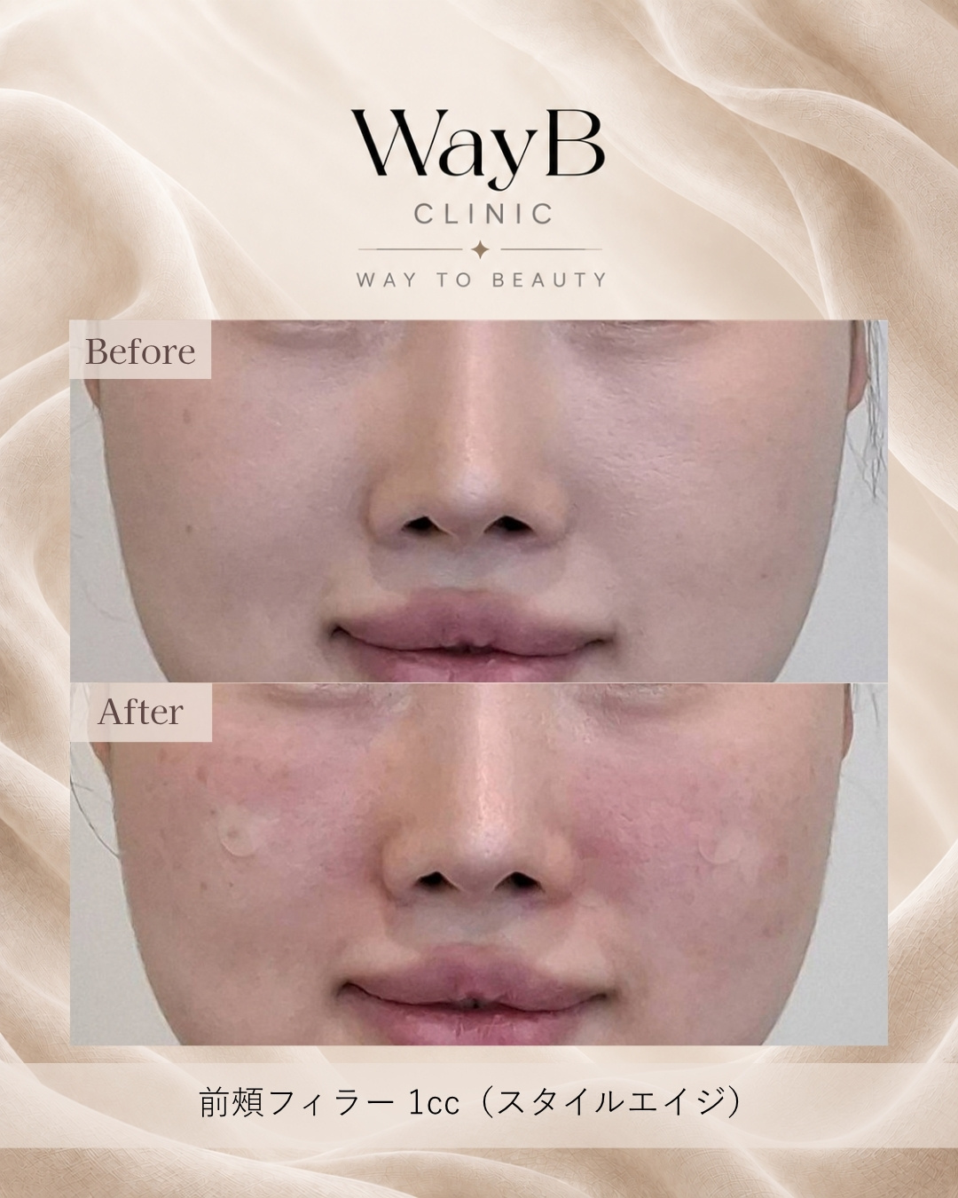 頬・頬骨前面のヒアルロン酸注入 Case 5 Before & After