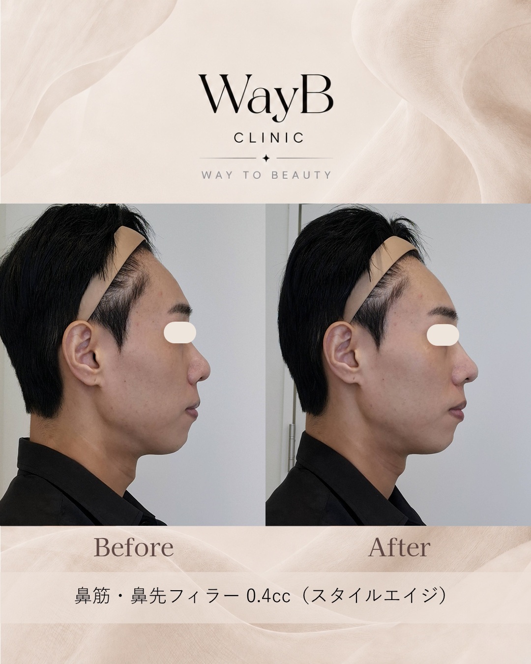 鼻のヒアルロン酸注入 Case 1 Before & After