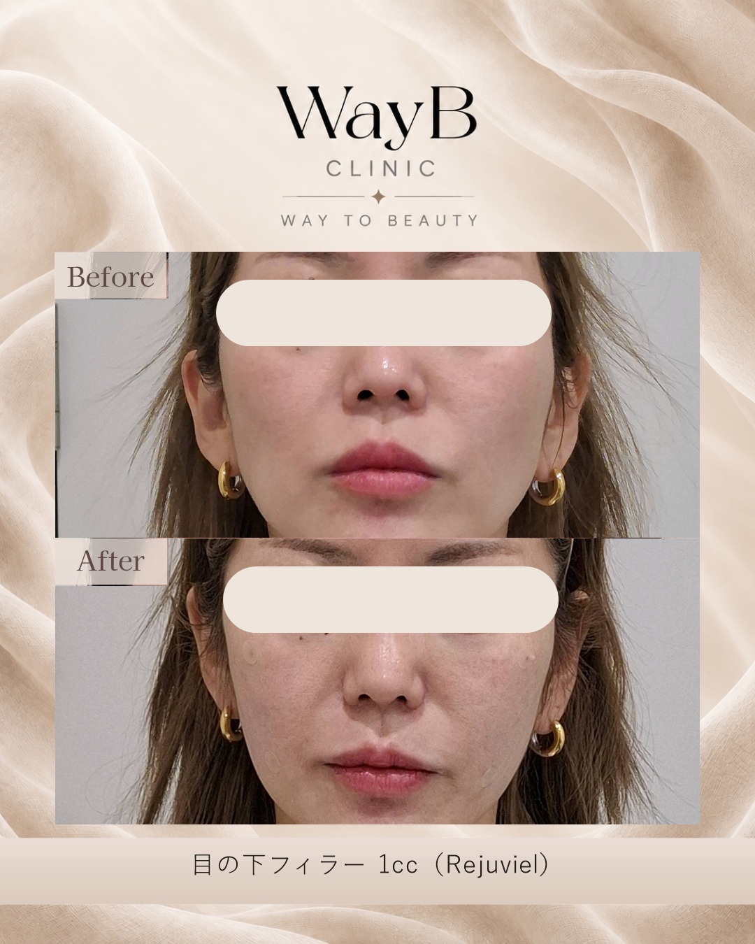 目の下のヒアルロン酸注入 Case 4 Before & After