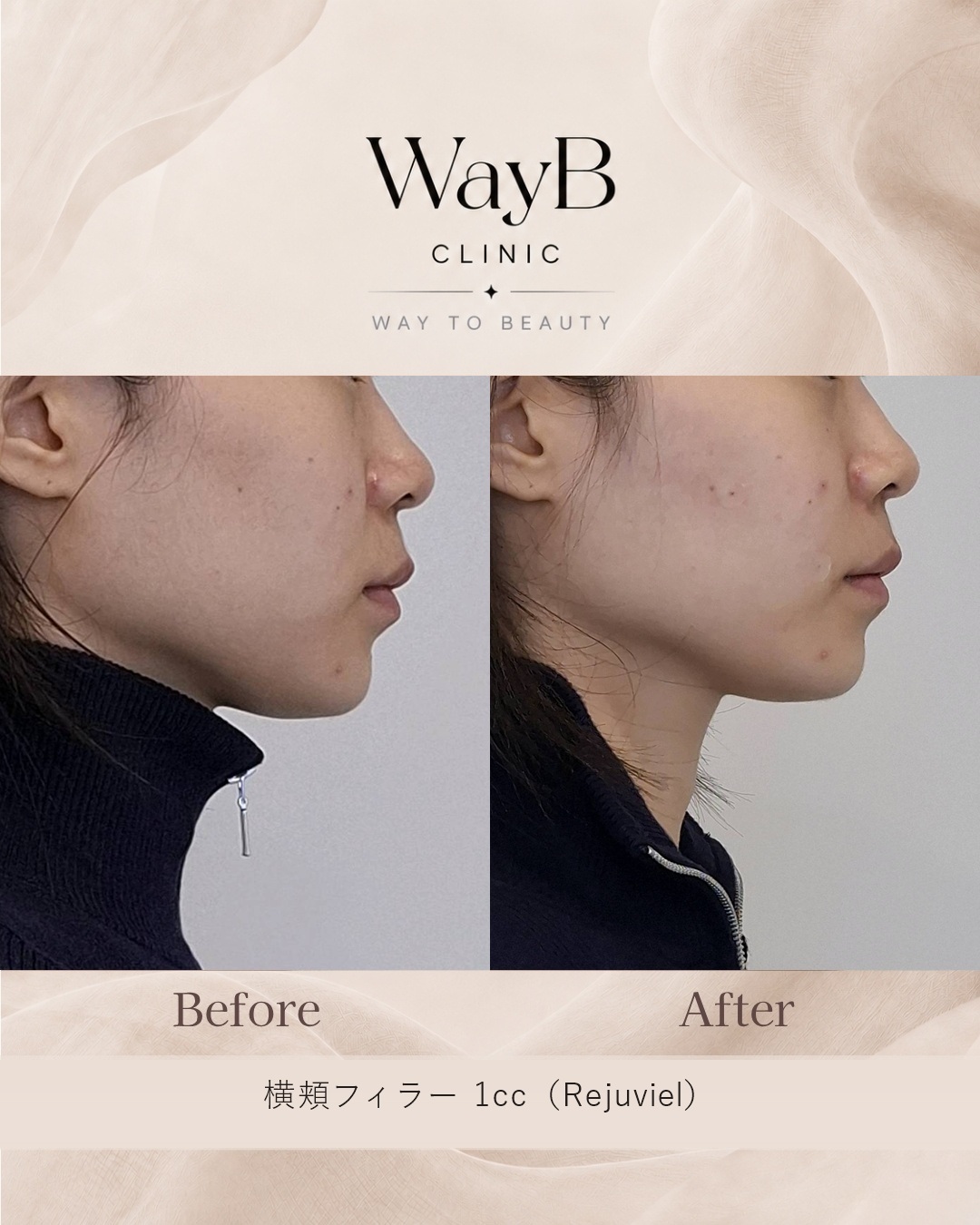 頬・頬骨前面のヒアルロン酸注入 Case 1 Before & After