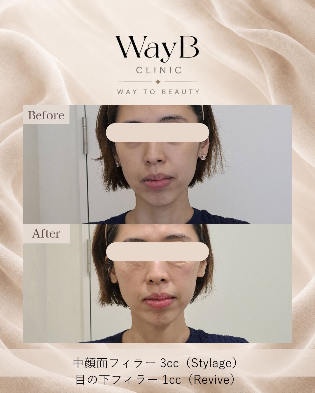 目の下のヒアルロン酸注入 Case 6 Before & After