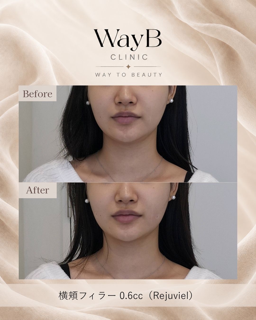 頬・頬骨前面のヒアルロン酸注入 Case 7 Before & After