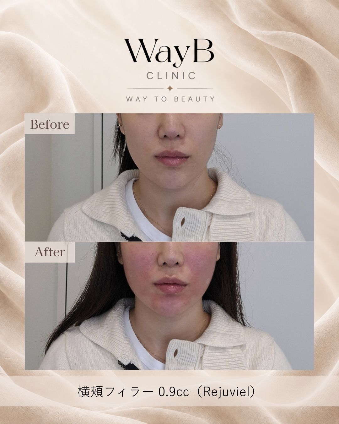 頬・頬骨前面のヒアルロン酸注入 Case 8 Before & After