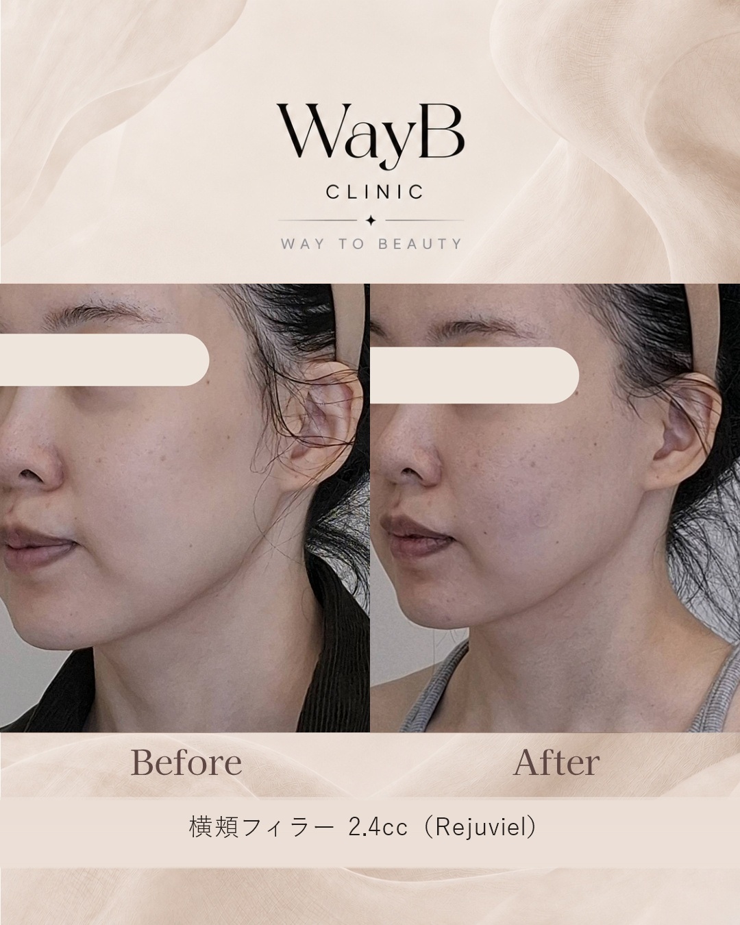 頬・頬骨前面のヒアルロン酸注入 Case 11 Before & After