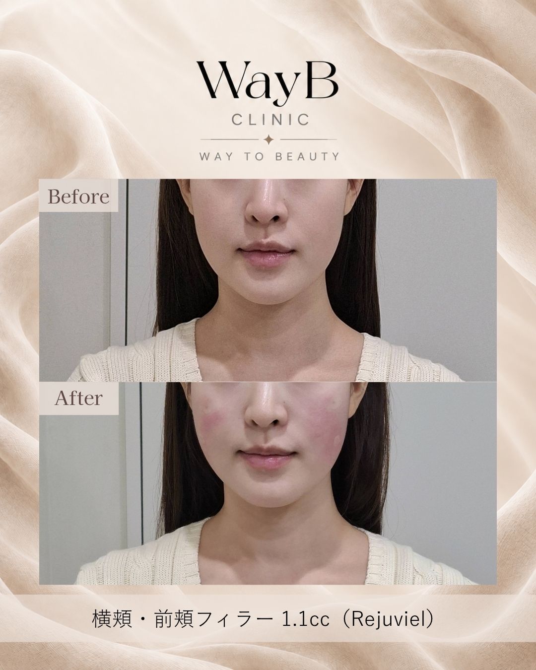 頬・頬骨前面のヒアルロン酸注入 Case 9 Before & After