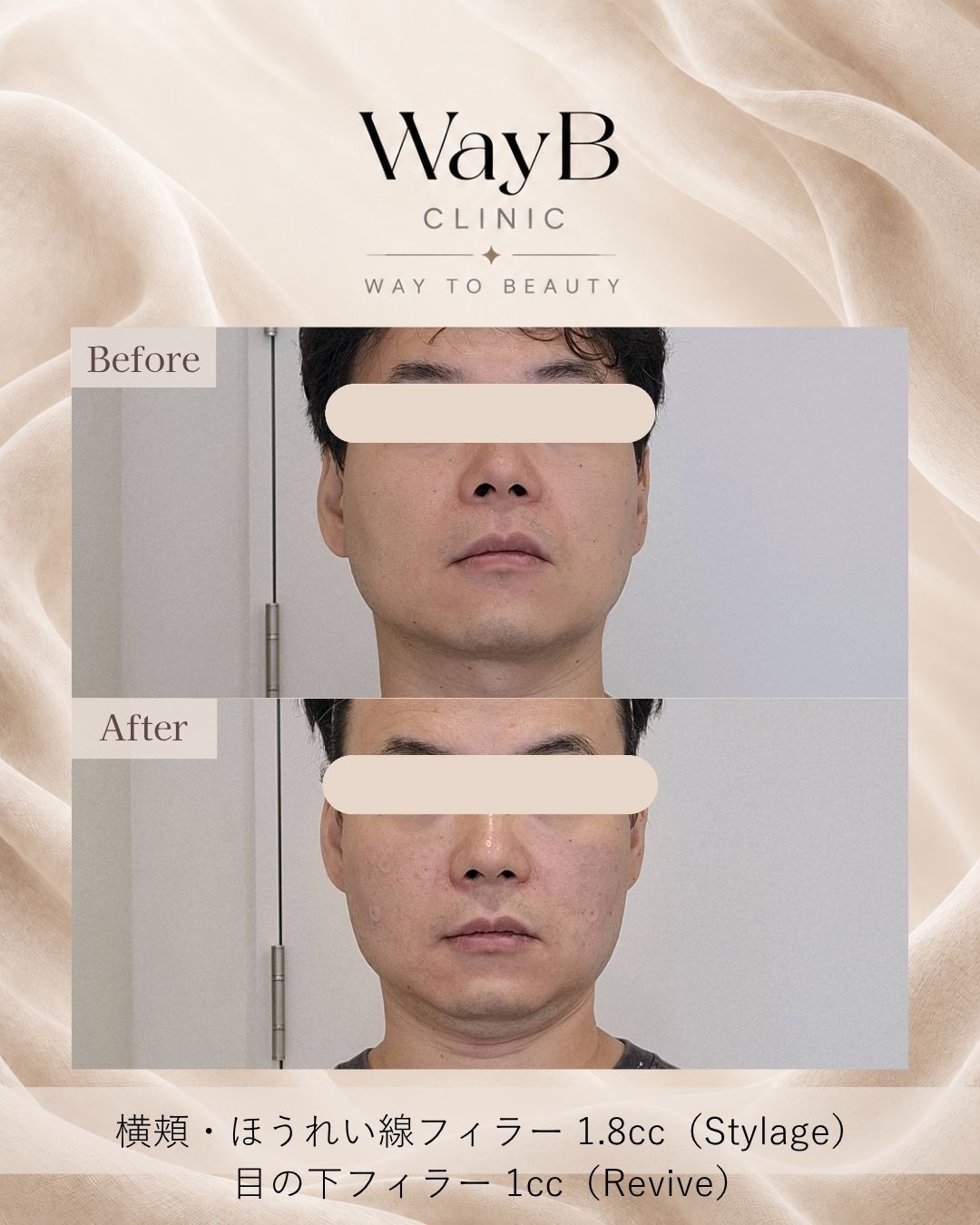 頬・頬骨前面のヒアルロン酸注入 Case 10 Before & After