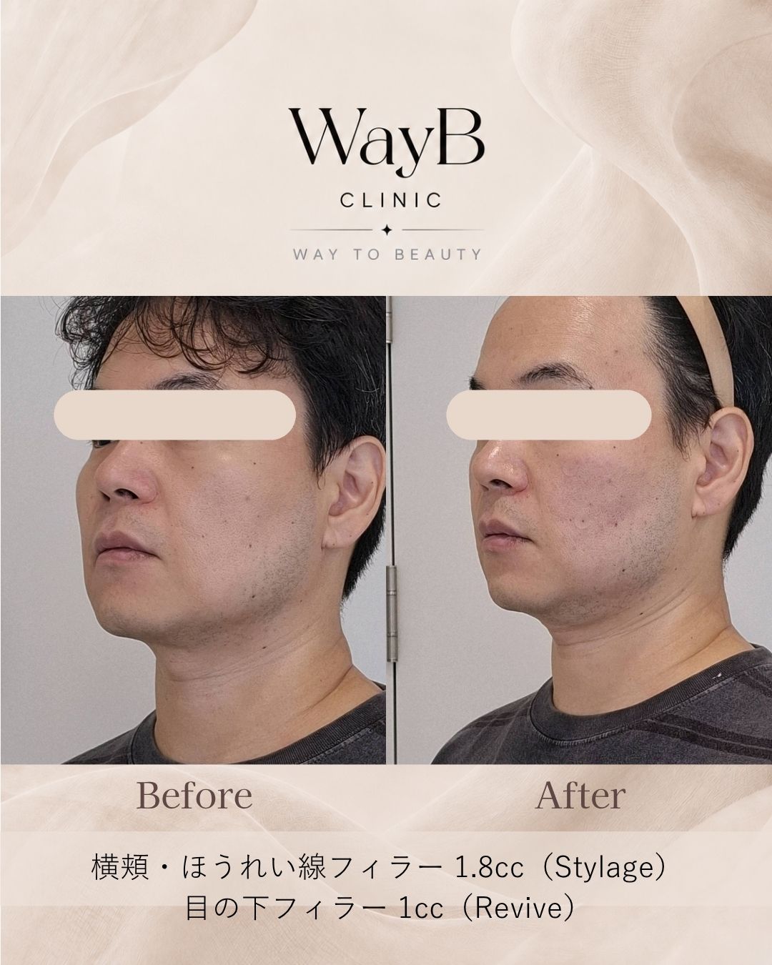 頬・頬骨前面のヒアルロン酸注入 Case 10 Before & After