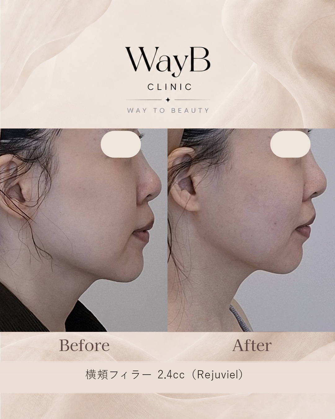 頬・頬骨前面のヒアルロン酸注入 Case 11 Before & After