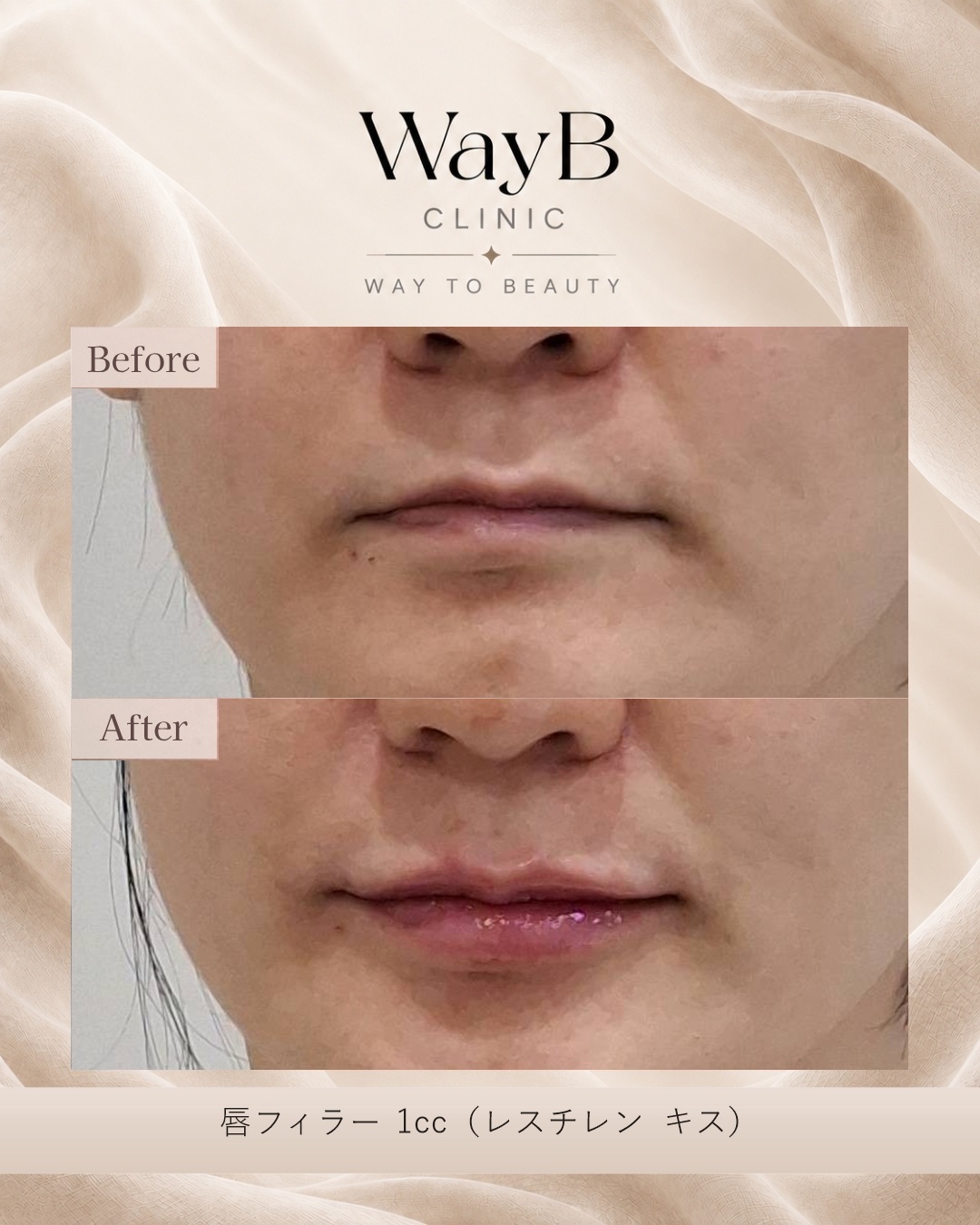 唇のヒアルロン酸注入 Case 13 Before & After