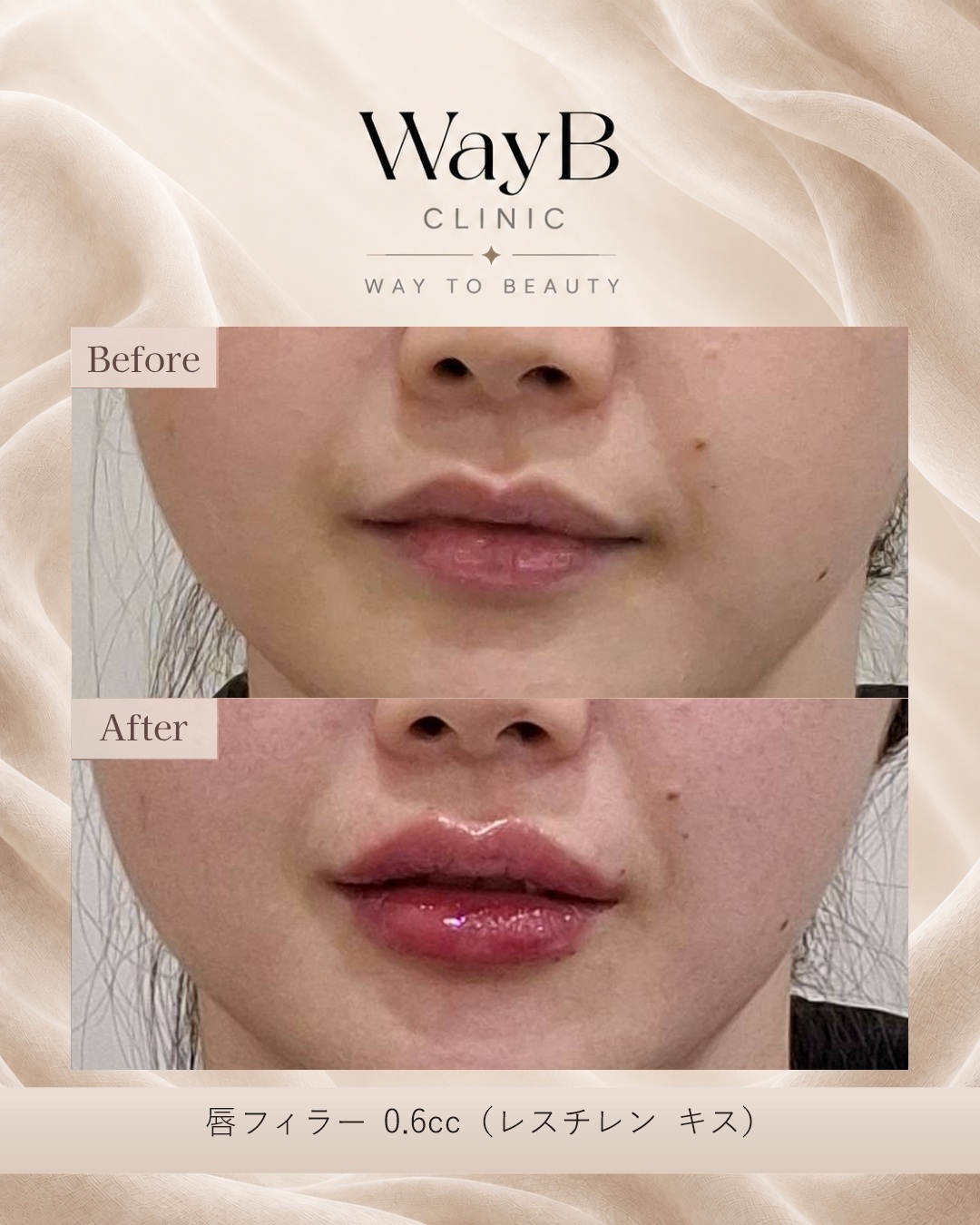唇のヒアルロン酸注入 Case 14 Before & After