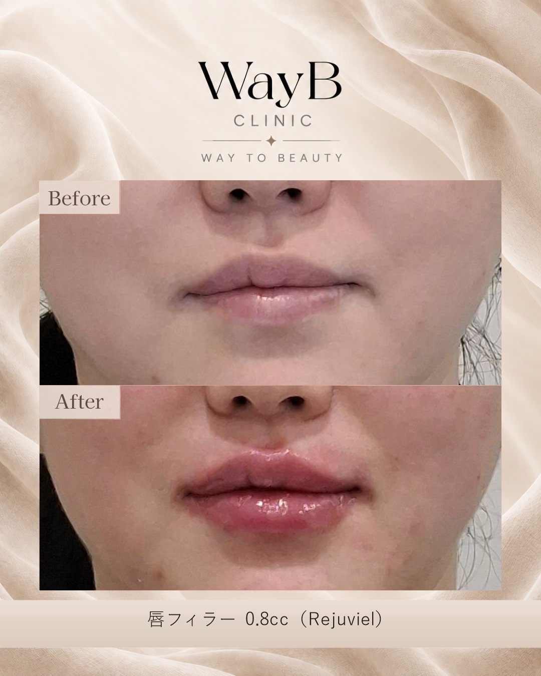 唇のヒアルロン酸注入 Case 12 Before & After
